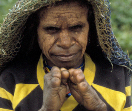Irian jaya woman with morning ritual related cut fingers.